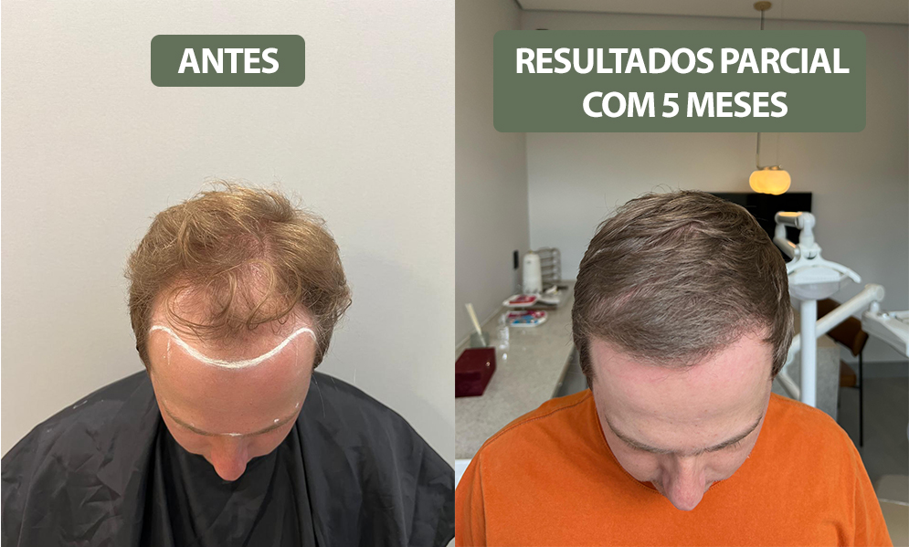 antes e depois final